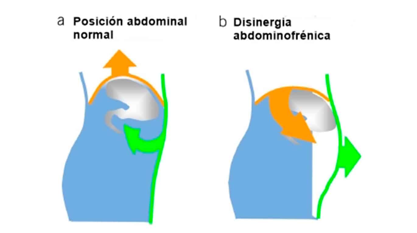 Advanced Health Laser hinchazon pared abdominal
