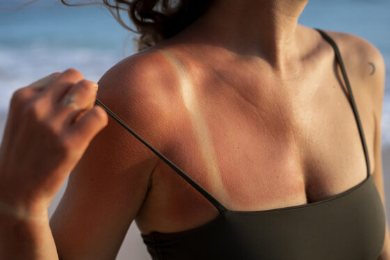 details woman s sunburn skin from beach sun 560x373jpg