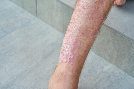 severe psoriasis man s leg close up 560x373jpg