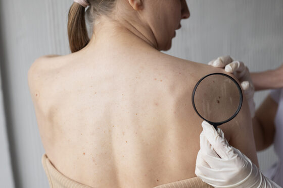 doctora diagnosticando un melanoma en el cuerpo de una paciente 560x373jpg